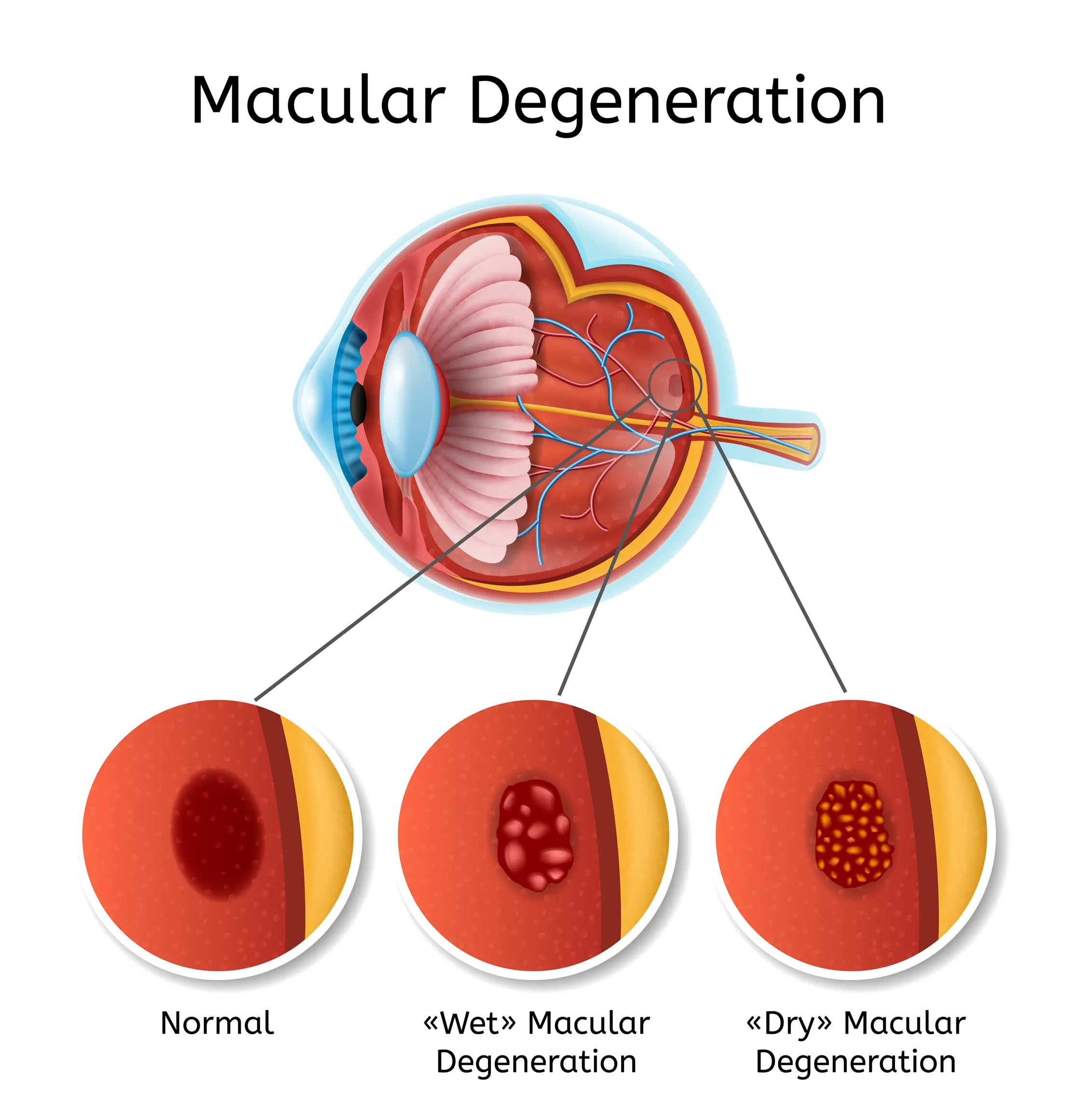 La dégénérescence maculaire liée à l'âge ou DMLA