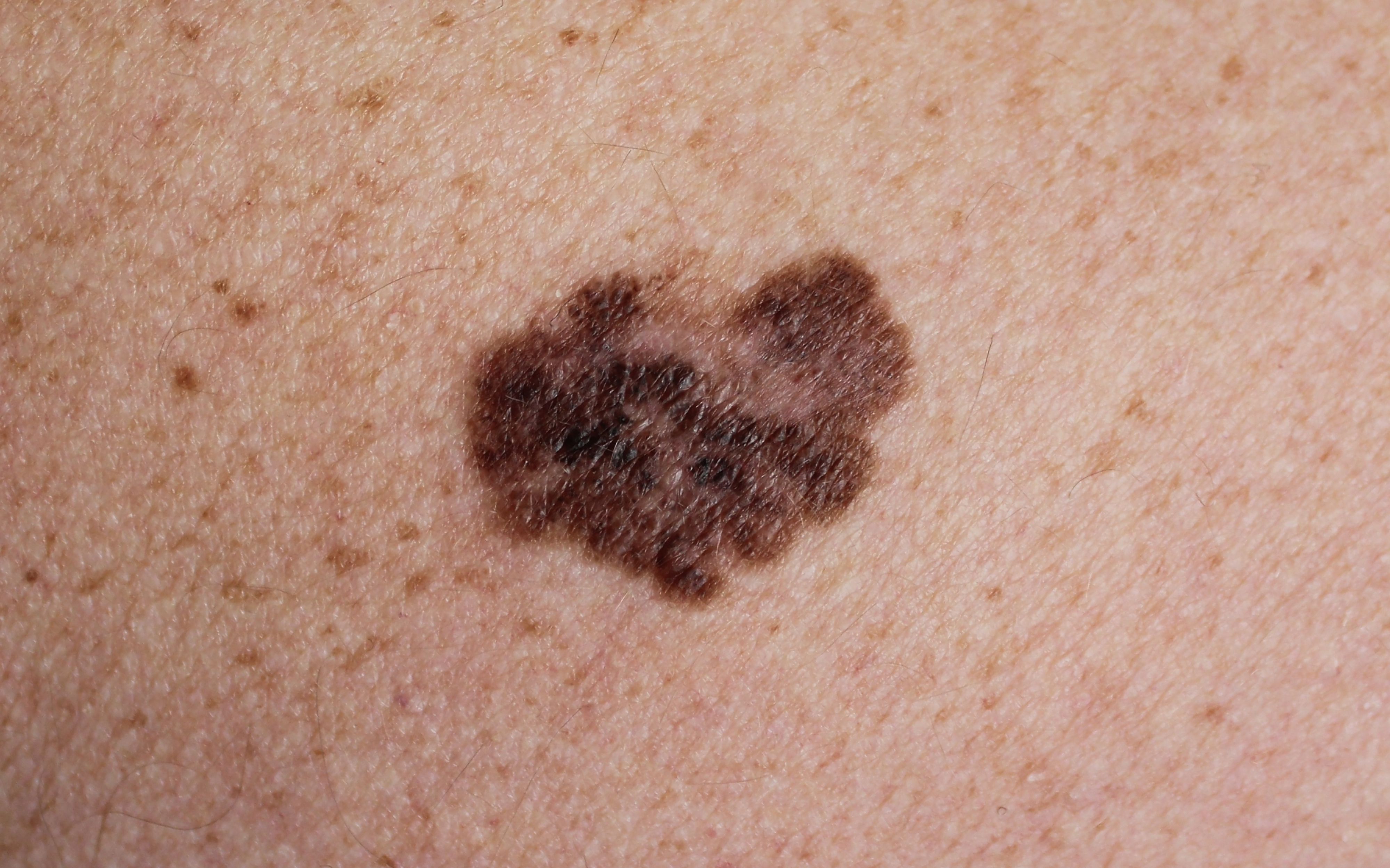photo melanome sur peau