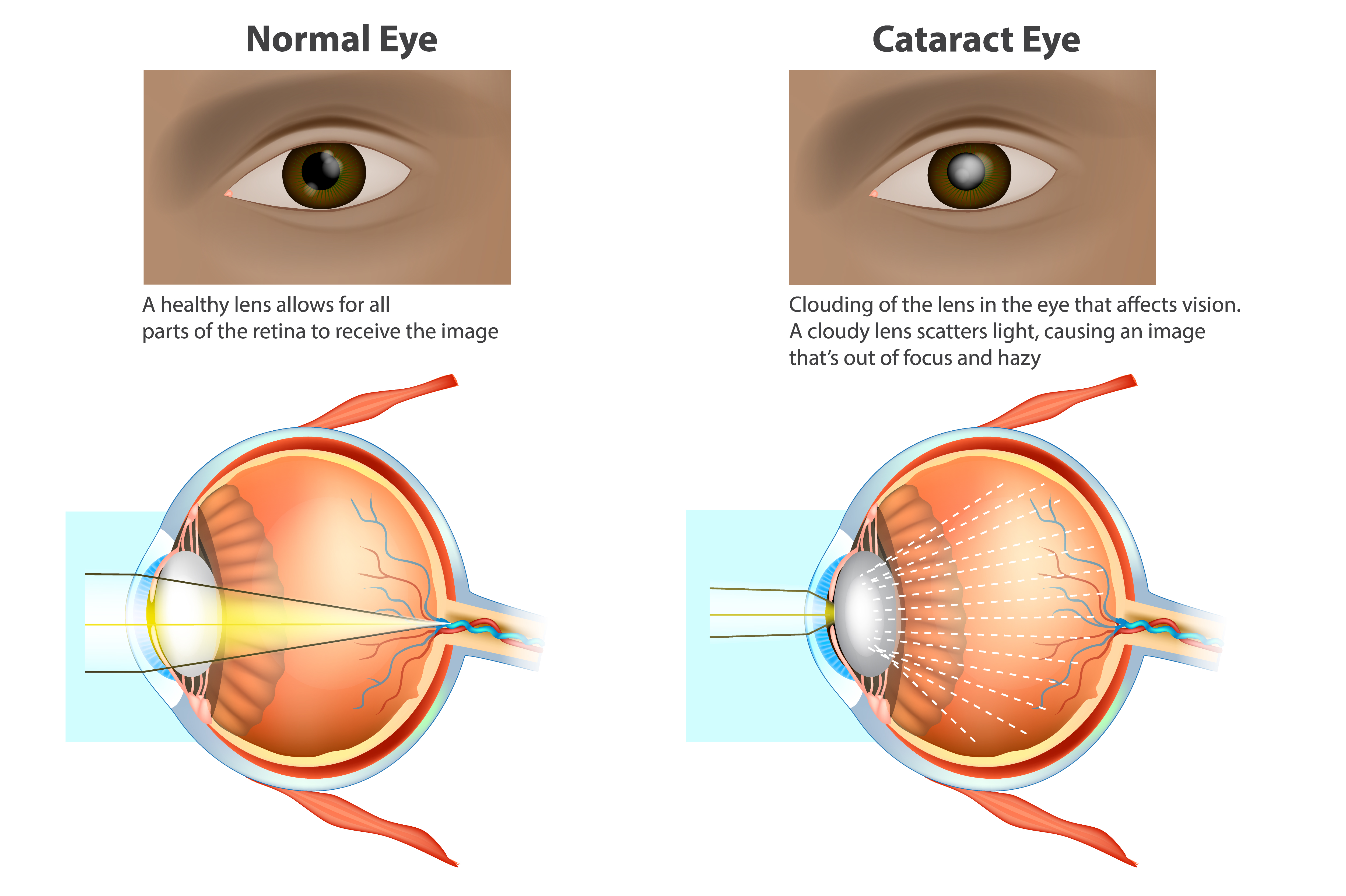cataracte et oeil normal