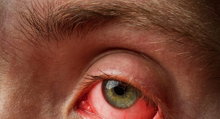 yeux rouge