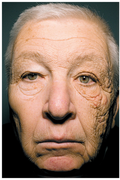 Photo d'un homme avec dommages des UV sur la peau